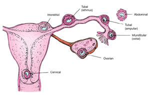 容易發生宮外孕的部位